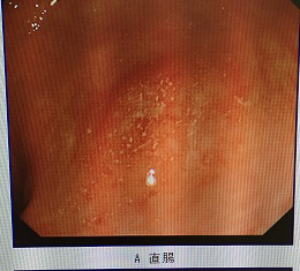 施術後の腸