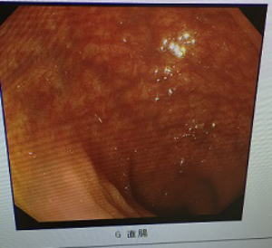 施術前の腸