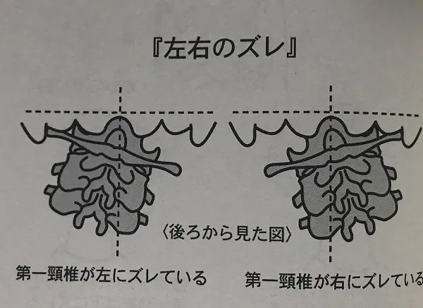 第一頚椎の左右のズレ