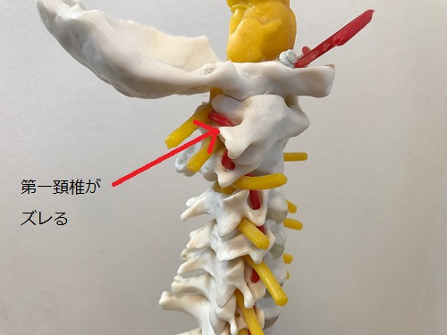 頚椎ヘルニアの原因は第一頚椎のズレ