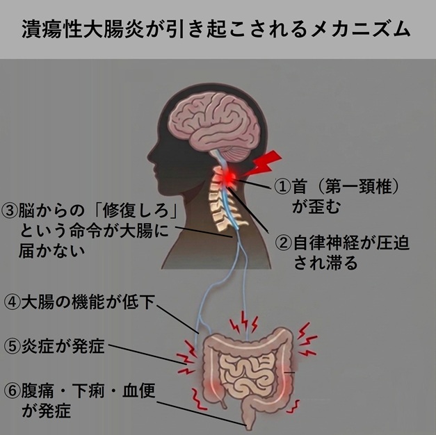 潰瘍性大腸炎が引き起こされるメカニズム